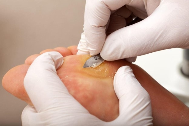 Corn & Callus Care