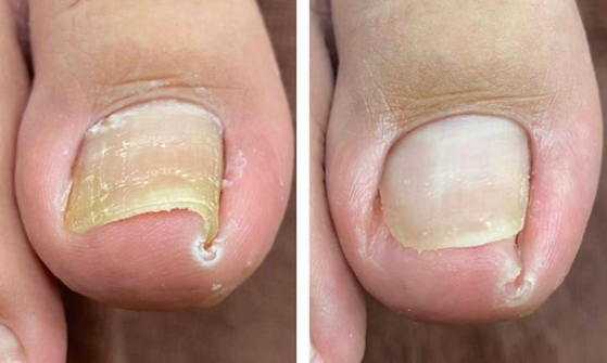 Ingrown Toenail Care