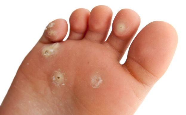 Wart Care